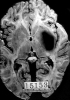 Contained hypertensive putaminal hemorrhage